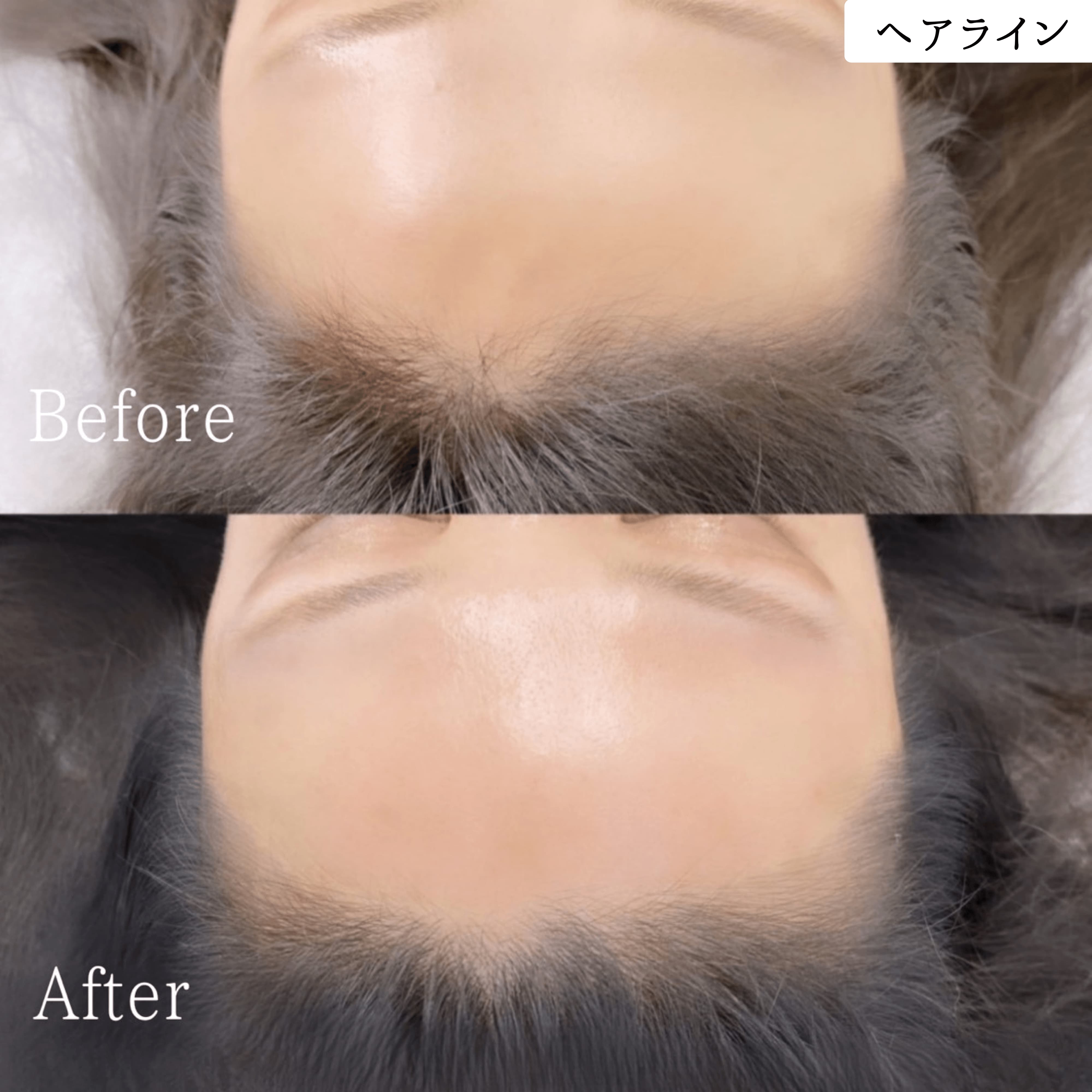 ヘアラインアートメイク 症例 ビフォーアフター｜東京・半蔵門 komi