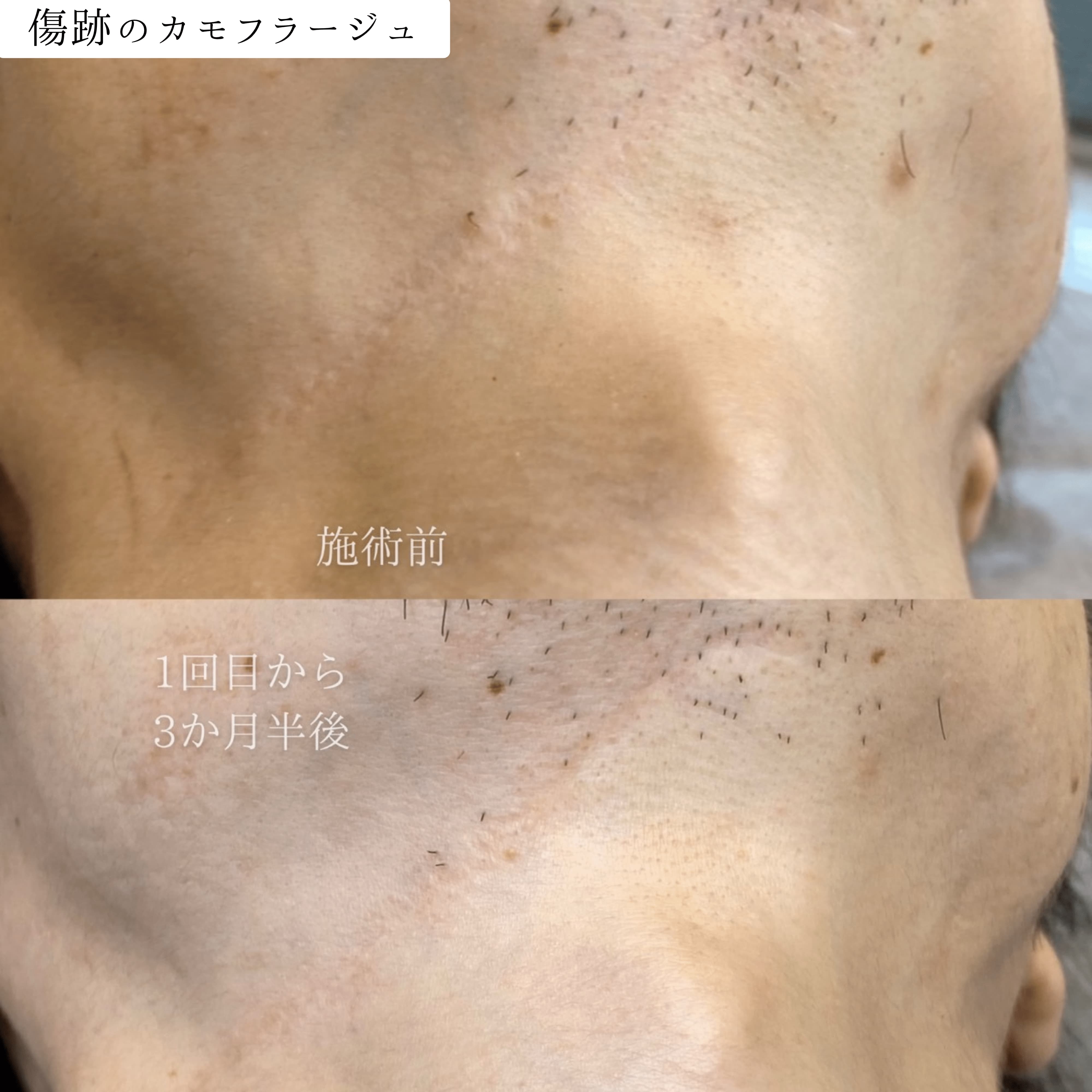 パラメディカルアートメイク 症例 ビフォーアフター｜東京・半蔵門 komi