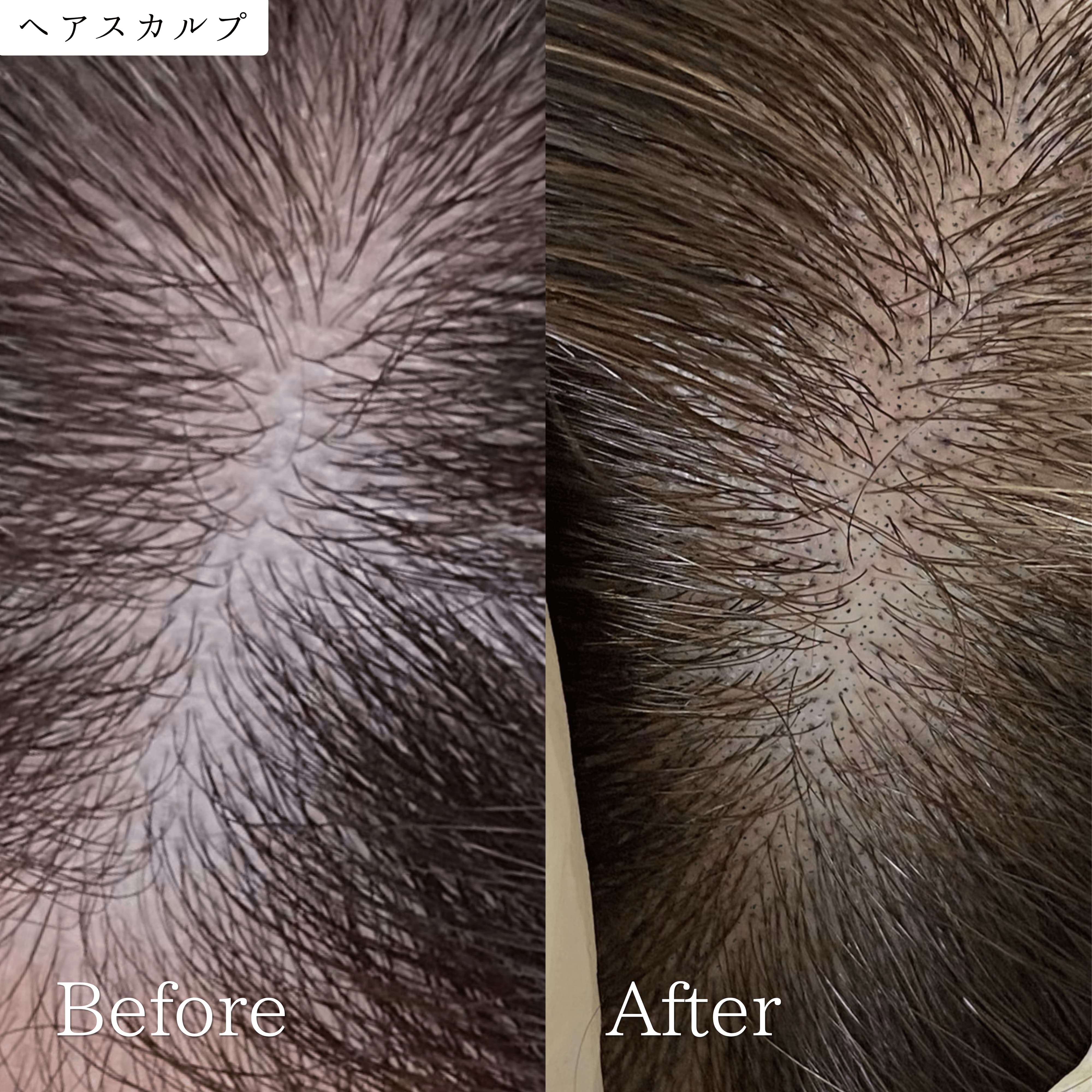 ヘアスカルプメディカルアートメイク 症例 ビフォーアフター｜東京・半蔵門 komi