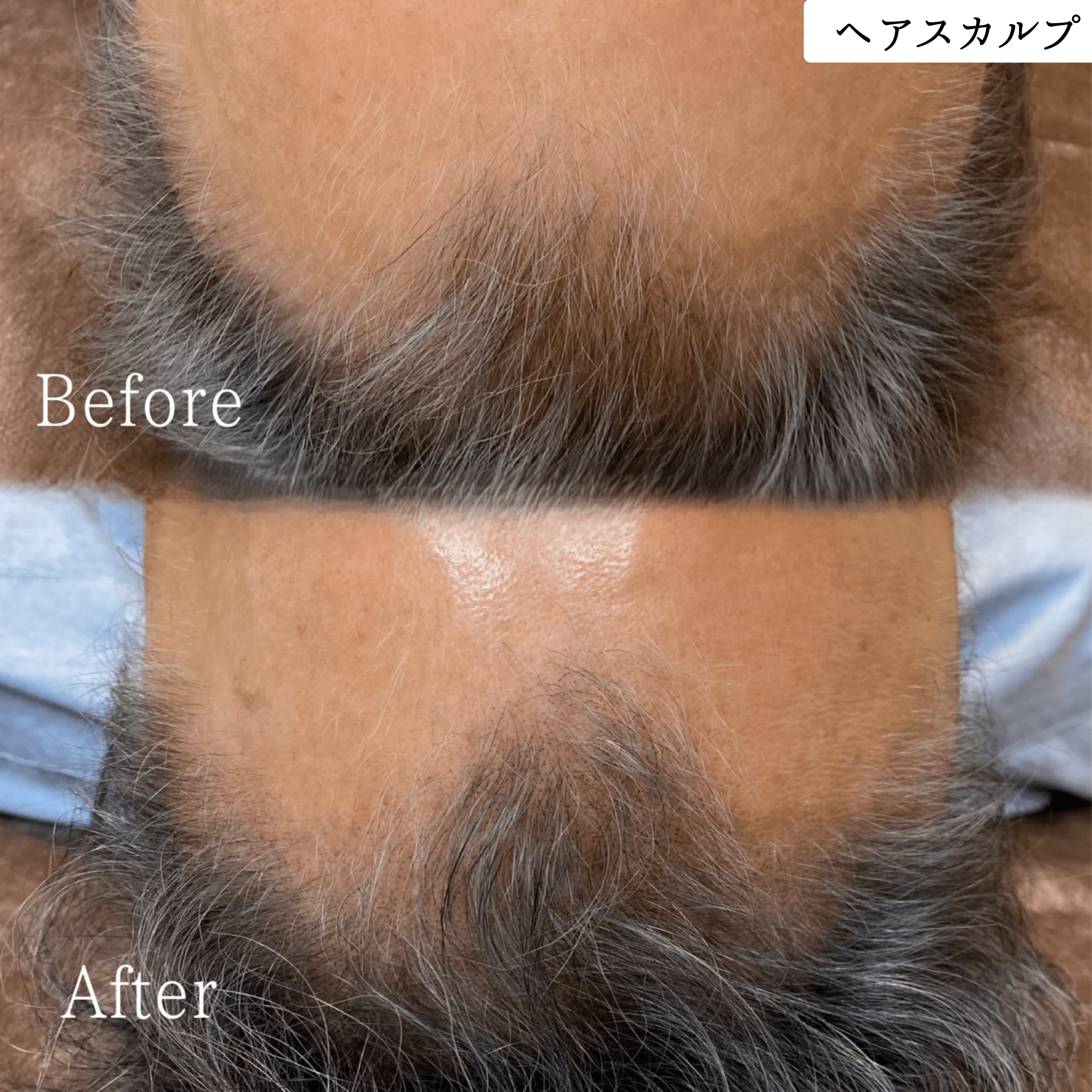 ヘアスカルプメディカルアートメイク 症例 ビフォーアフター｜東京・半蔵門 komi